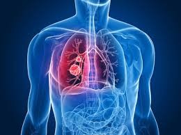Možni zdravstveni učinki dihal vključujejo azbestozo, pljučni rak, kronični bronhitis, fibrozo, emfizem in zmanjšano oskrbo s kisikom v krvi